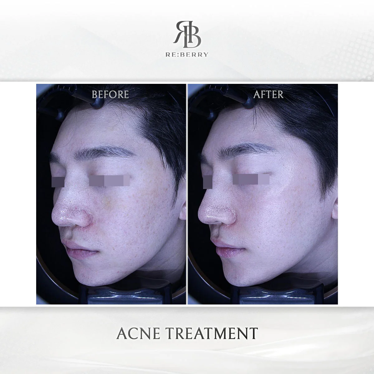 Same-day acne treatment before and after